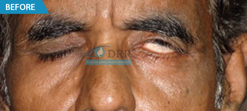 facial paralysis surgery in Chennai